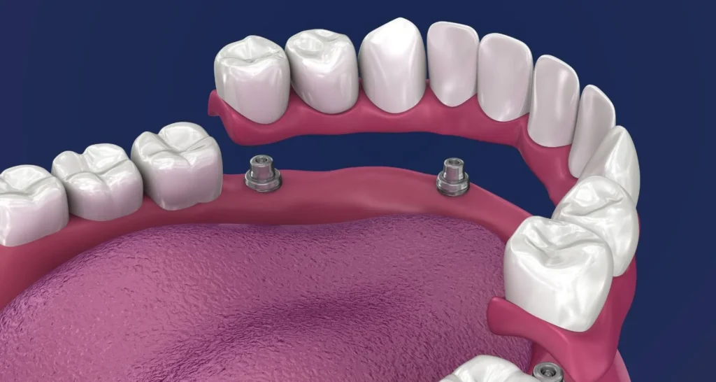 Dental Implants On The NHS (Eligibility, Costs & NHS Criteria) 6 Dental Implants On The NHS