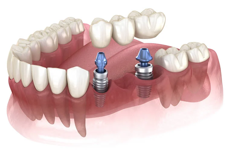 Dental Implants UK (2025 Prices, Finance & Downsides) 6 Dental Implants UK