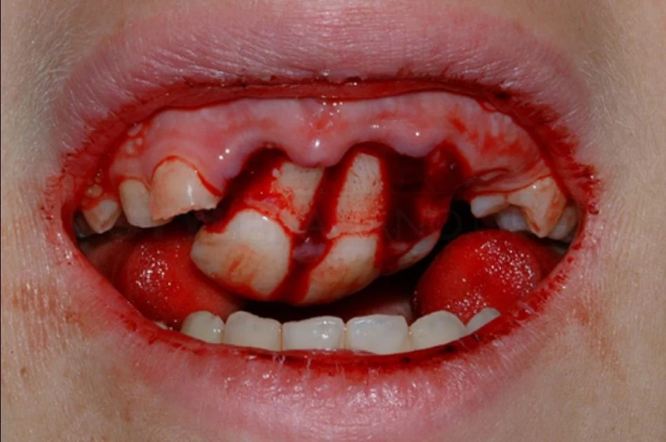 Dental Trauma (First Aid & Healing Time) 17 Dental Trauma