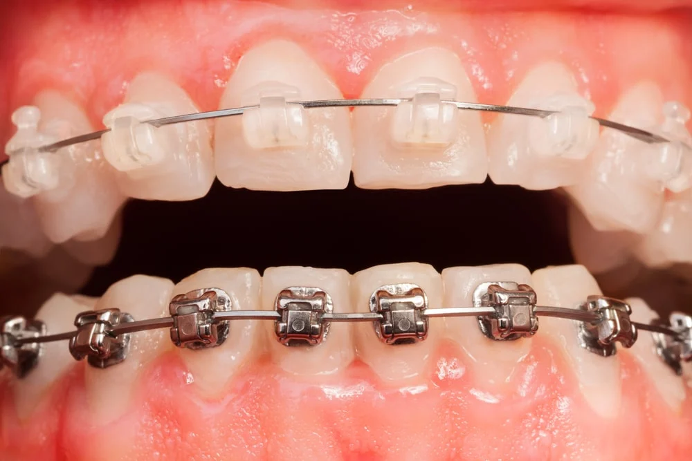 Fixed Braces (Types, Costs, Pain Levels & Facial Changes) 21 Fixed Braces1 Fixed Braces (Types, Costs, Pain Levels & Facial Changes)