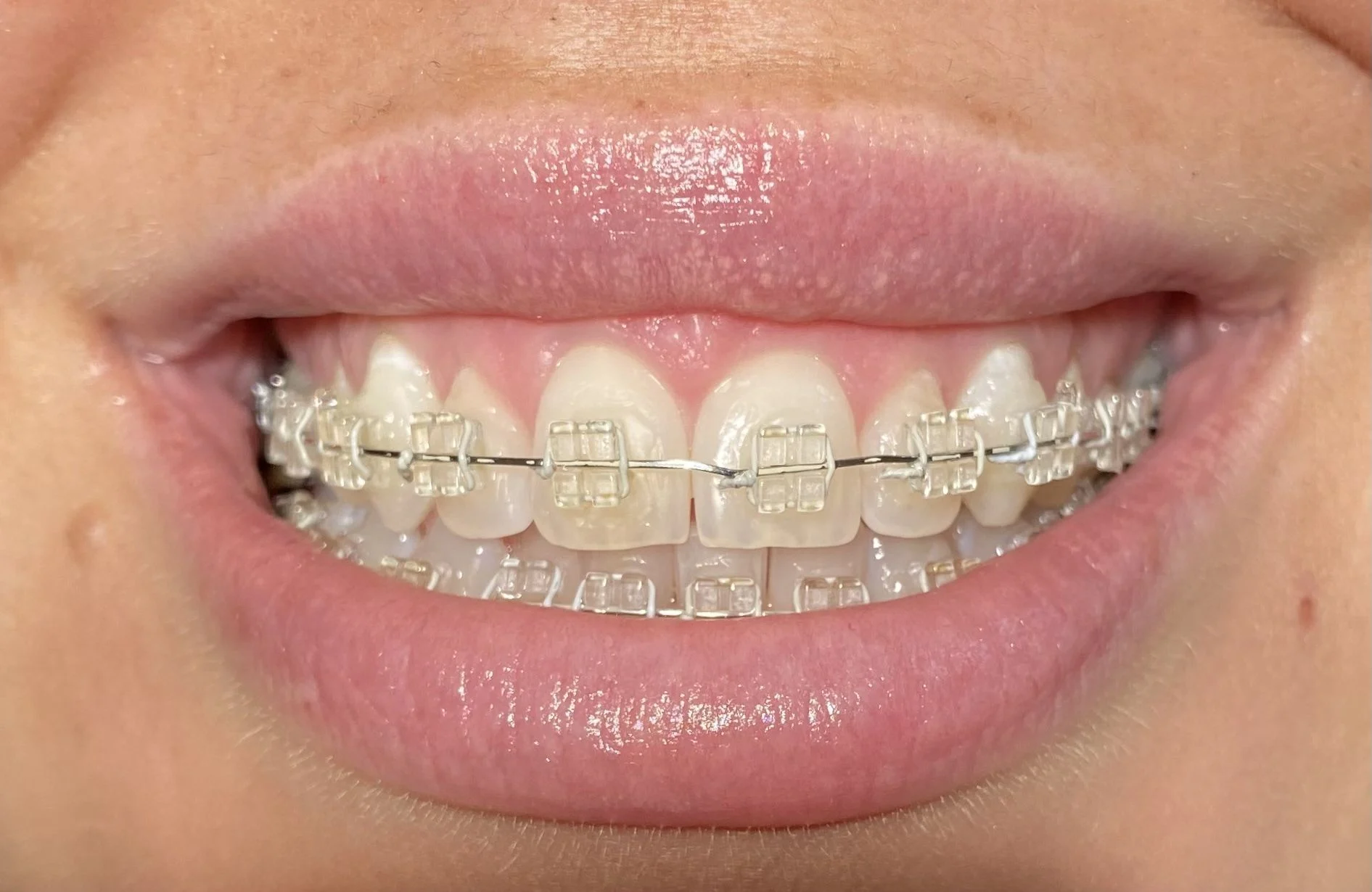 Fixed Braces (Types, Costs, Pain Levels & Facial Changes) 22 Fixed Braces2 Fixed Braces (Types, Costs, Pain Levels & Facial Changes)