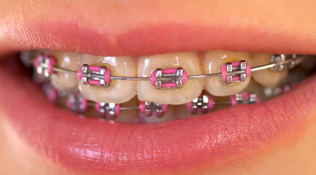 Fixed Braces (Types, Costs, Pain Levels & Facial Changes) 24 Fixed Braces4 Fixed Braces (Types, Costs, Pain Levels & Facial Changes)