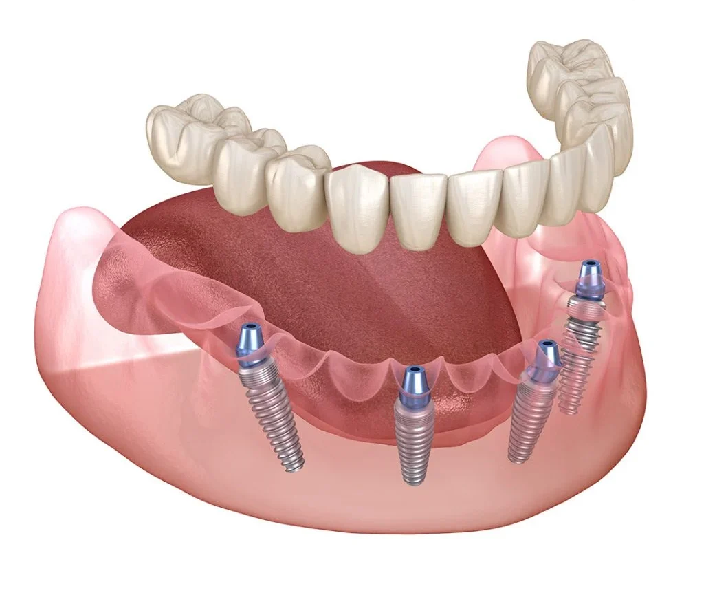 Full Mouth Dental Implants (UK Cost & Same Day Options) 6 Full Mouth Dental Implants