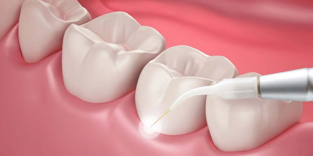 Gum Disease Treatment (Causes, Treatments & Natural Remedies Explained) 23 Gum Disease Treatment3 Gum Disease Treatment (Causes, Treatments & Natural Remedies Explained)