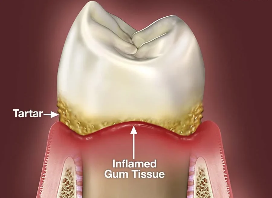 How To Cure Gum Disease Without A Dentist