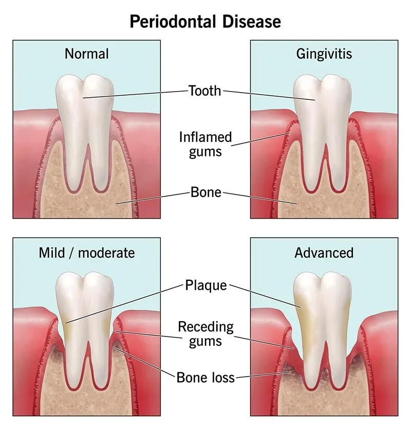 How To Cure Gum Disease