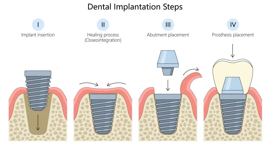 Implant Procedure (Pain, Anesthesia & Recovery Stages) 6 Implant Procedure