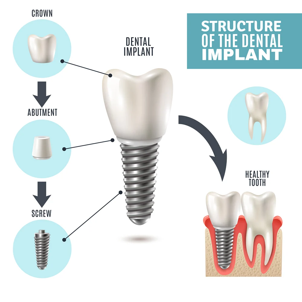 Implant Procedure