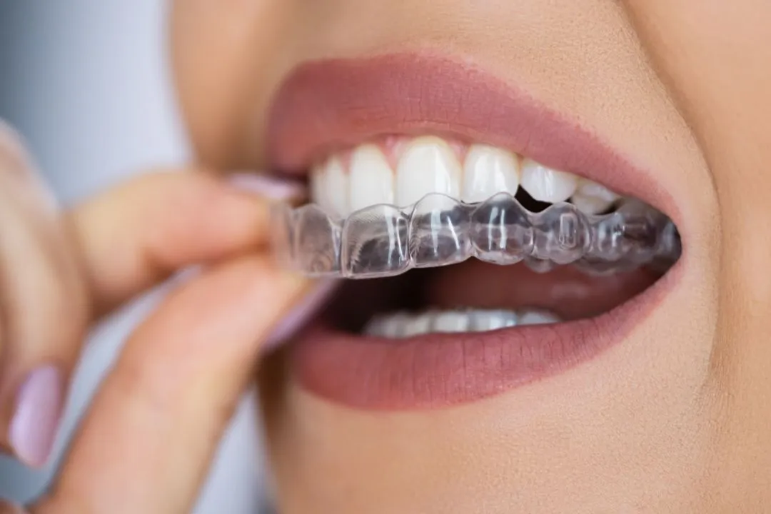 Invisible Aligners(Costs, Comfort, Risks & Who Should Avoid Them) 21 Invisible Aligners Invisible Aligners(Costs, Comfort, Risks & Who Should Avoid Them)