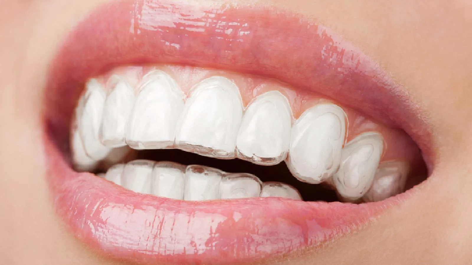 Invisible Aligners(Costs, Comfort, Risks & Who Should Avoid Them) 22 Invisible Aligners1 Invisible Aligners(Costs, Comfort, Risks & Who Should Avoid Them)