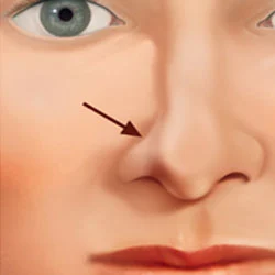 Nostril Collapse (Symptoms, Rhinoplasty & LATERA Fixes) 4 Nostril Collapse