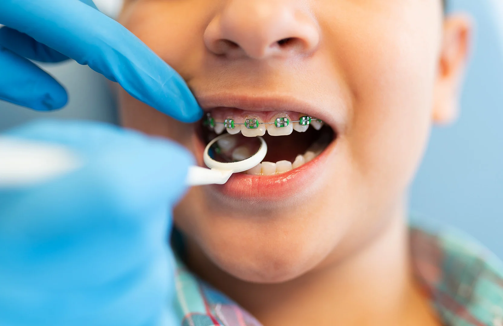 Orthodontic for Kids3 Orthodontics For Kids (Best Age, Braces Types & Early Signs)