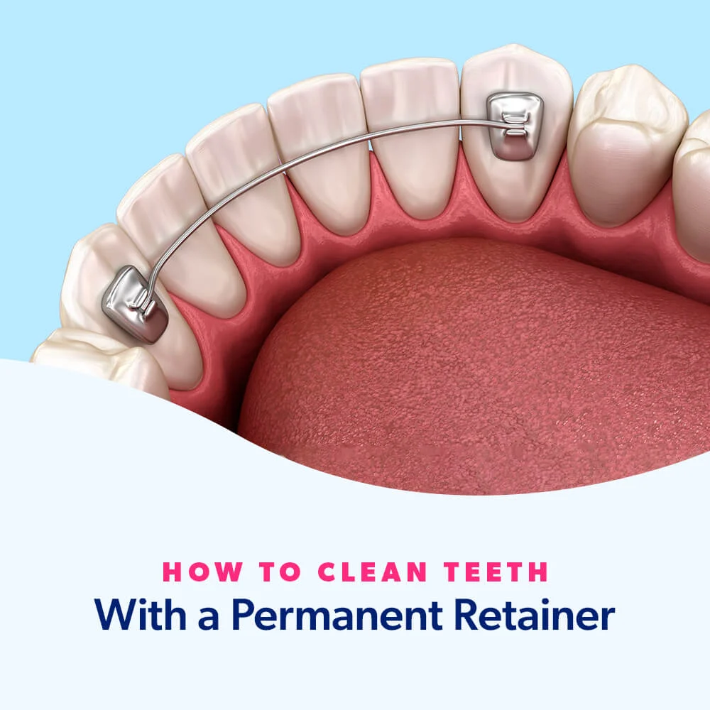 PERMANENT BRACES1 PERMANENT BRACES (Fixed Retainers, Cost & Lifespan)
