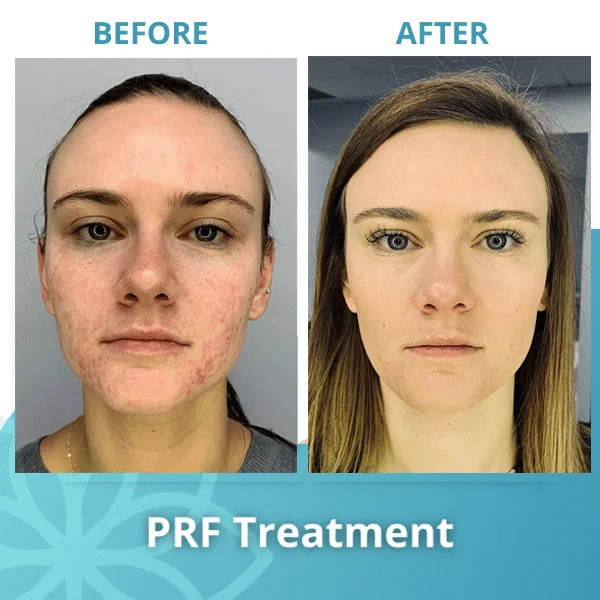 PRF Treatment Benefits, Cost, Safety (Under Eye, Hair) 6 PRF Treatment