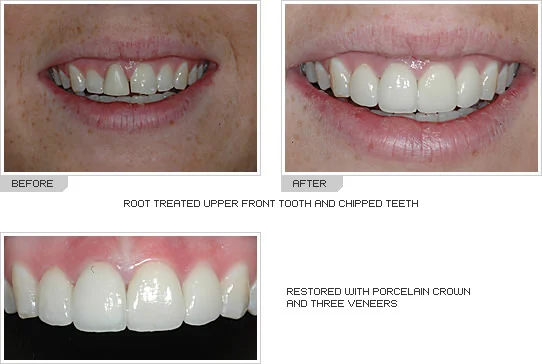 Porcelain Caps Dental Crowns (Cost, Lifespan, Natural Look) 18 Porcelain Caps Dental Crowns