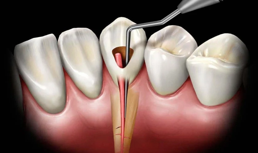 Root Canal And Pain After (Managing Pain & Whats Not Normal) 6 Root Canal And Pain After