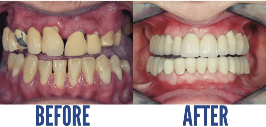 TEETH RECONSTRUCTION1 e1747230148143 TEETH RECONSTRUCTION: REBUILD YOUR SMILE (Benefits & Cost)