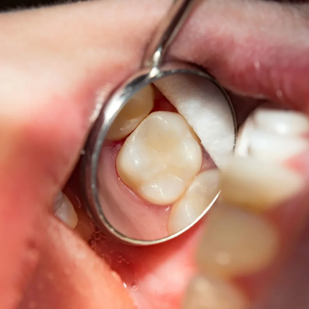 TOOTH CAVITY FILLING PRICE (MATERIALS, INSURANCE & LOCATION) 6 TOOTH CAVITY FILLING PRICE