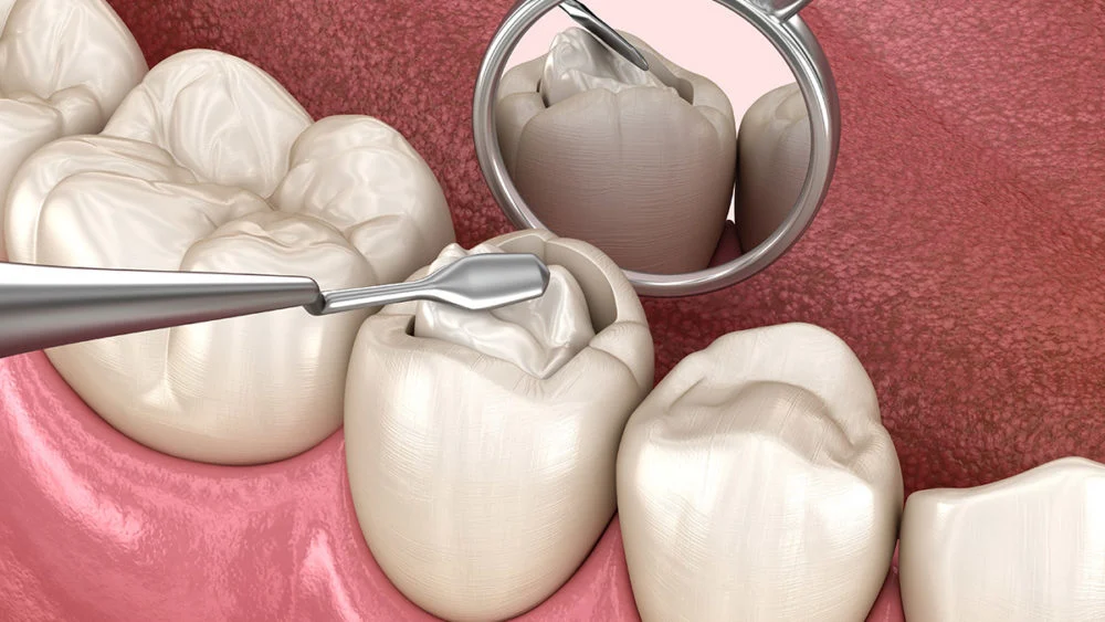 TOOTH CAVITY FILLING PRICE (MATERIALS, INSURANCE & LOCATION) 1 TOOTH CAVITY FILLING PRICE