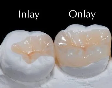 Teeth Inlays And Onlays (Comparing Crowns & Materials) 6 Teeth Inlays And Onlays
