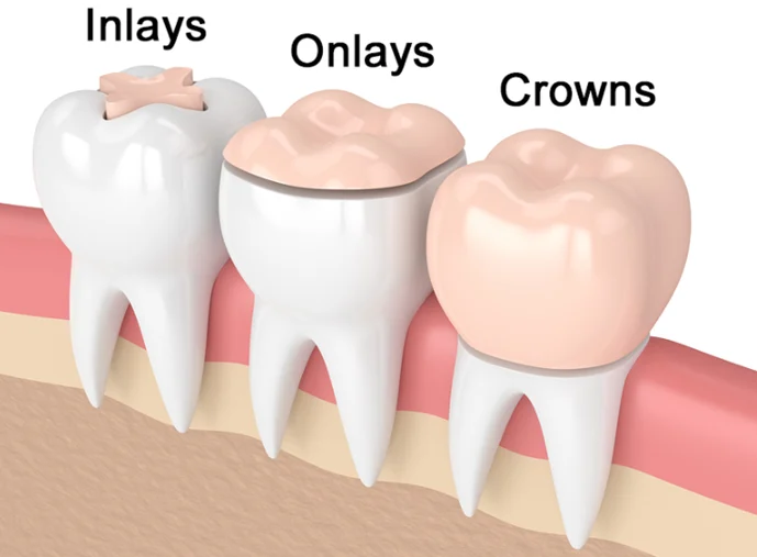 Teeth Inlays And Onlays (Comparing Crowns & Materials) 17 Teeth Inlays And Onlays
