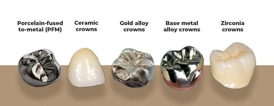 Types Of Crowns (Cost, Strength & Appearance Compared) 16 Types Of Crowns
