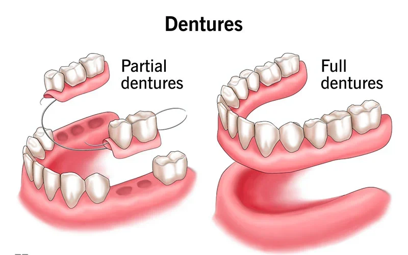 Types Of False Teeth (Fixed, Removable, & Implant Options) 6 Types Of False Teeth