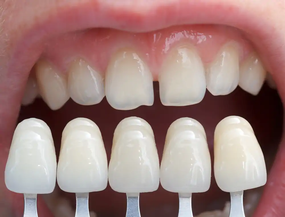Veneers Cost NHS (UK and Turkey Types) 6 Veneers Price
