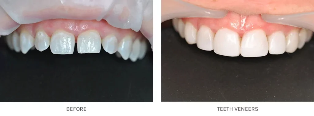 Veneers Cost NHS (UK and Turkey Types) 12 Veneers Price