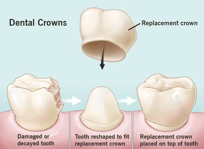 What Is A Crown (Types, Materials & Purpose) 6 What Is A Crown