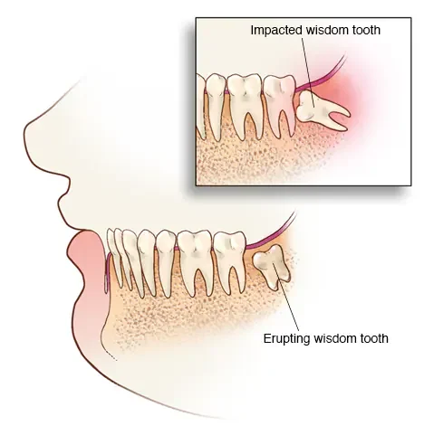 Wisdom Extraction (Pain, Recovery, Risks) 6 Wisdom Extraction