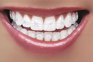 Clear Teeth Braces (Cost, Effectiveness & Age Limits) 6 clear teeth braces