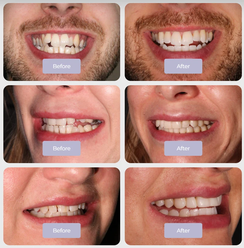 invisalign price uk