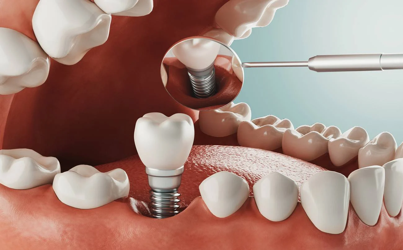 single tooth implant1 Single Tooth Implant (Cost, Pain, Timeline & Safety)