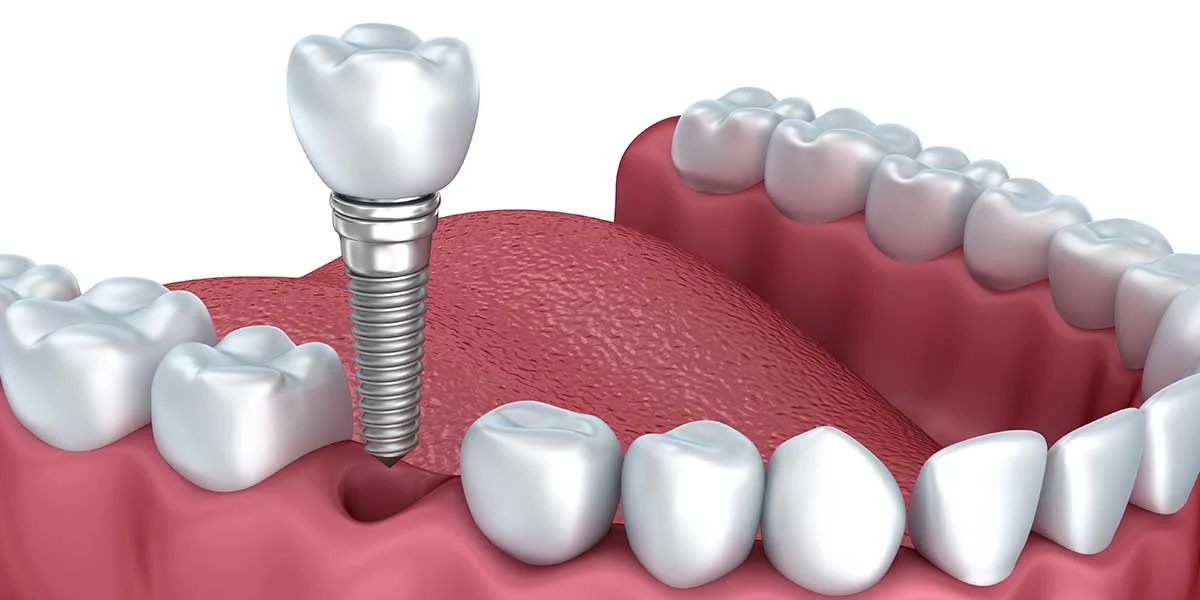 single tooth implant2 Single Tooth Implant (Cost, Pain, Timeline & Safety)
