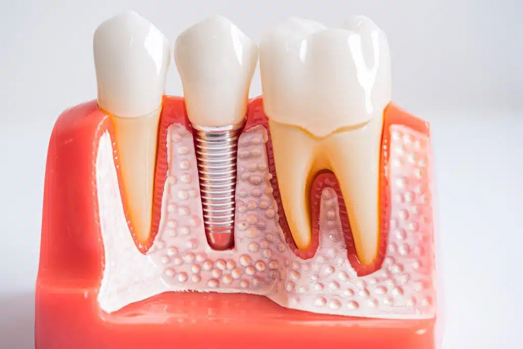single tooth implant3 Single Tooth Implant (Cost, Pain, Timeline & Safety)