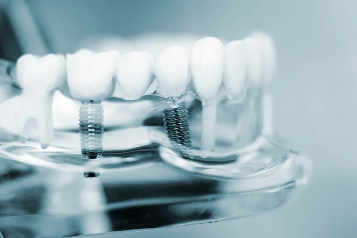single tooth implant4 Single Tooth Implant (Cost, Pain, Timeline & Safety)