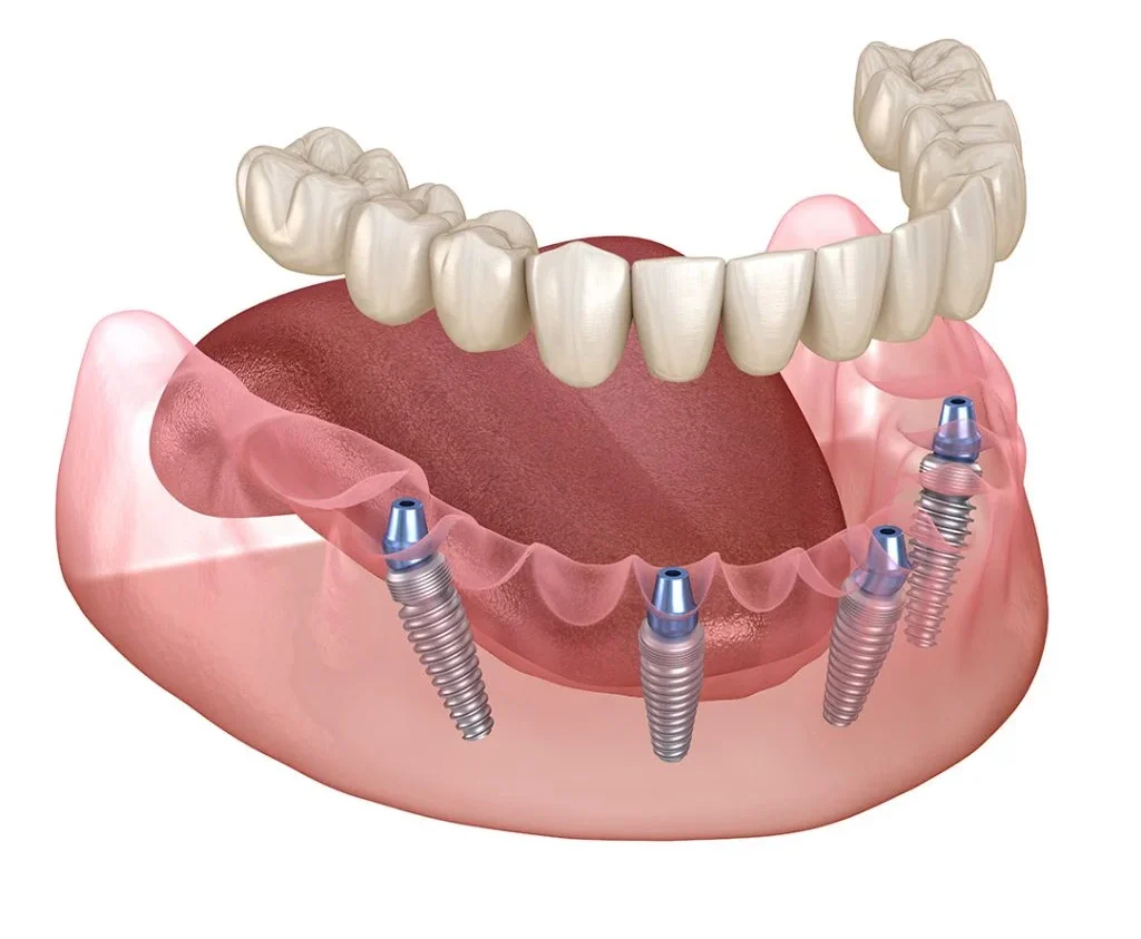 whole mouth dental implants 1 1 e1746862866938 Whole Mouth Dental Implants (UK Cost, Procedure & All-On-4)