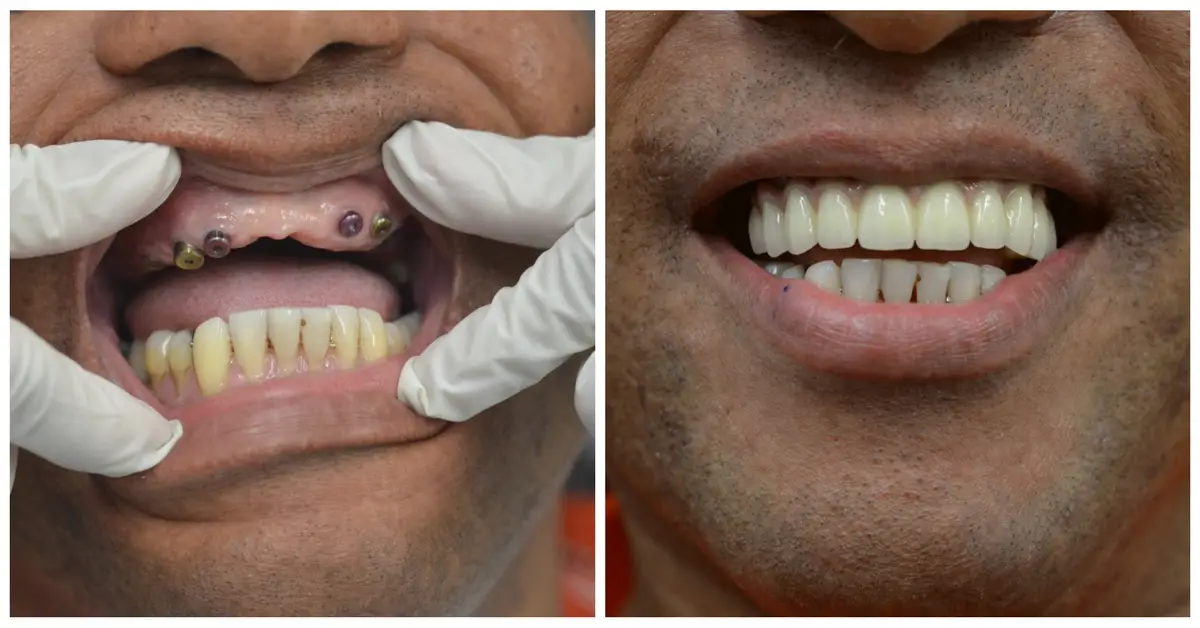 whole mouth dental implants 