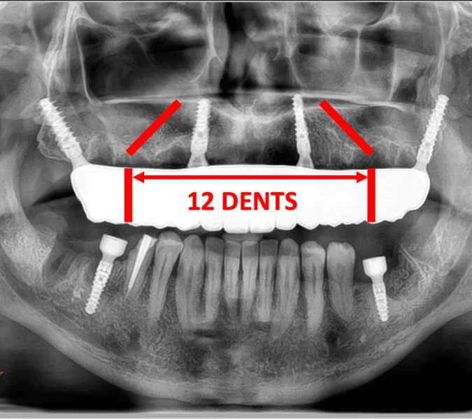 Implant Ptérygoïdien