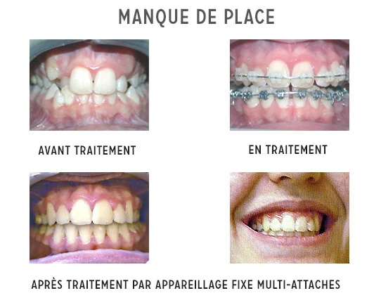 traitement orthodontique