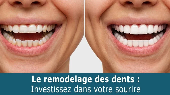 remodelage dentaire