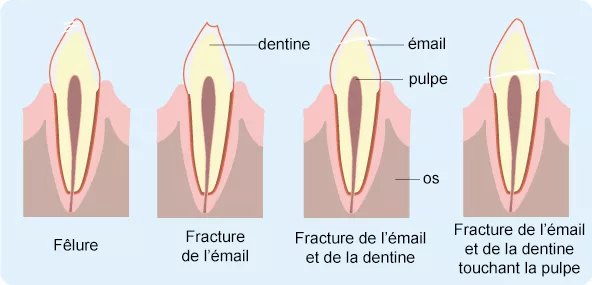 traumatisme dentaire
