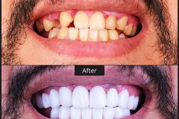 DENTAL IMPLANTS TURKEY