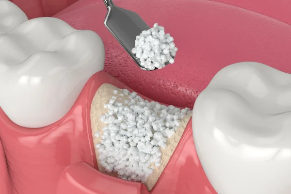 Dental Bone Graft Cost