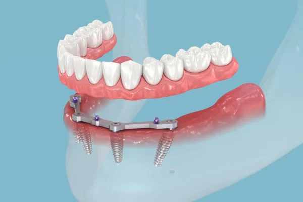 Dental Implants All On Four