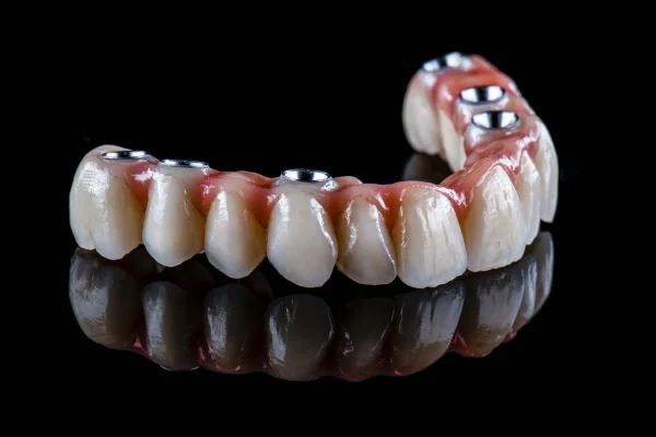 Full Mouth Dental Implants1