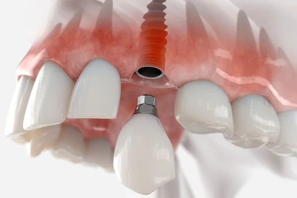 Immediate load dental implants